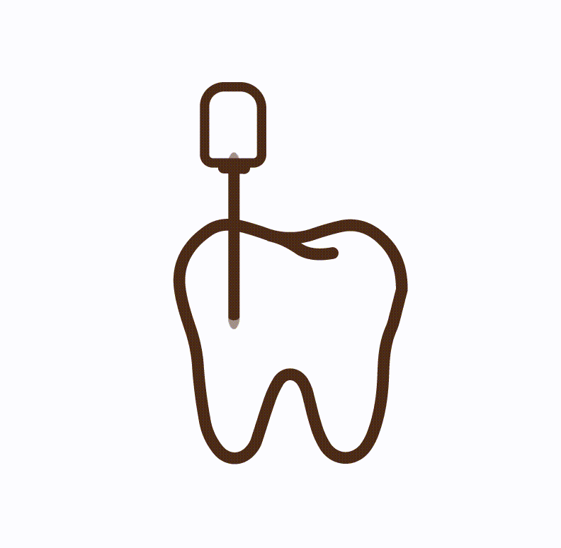 Root Canal Treatment (RCT)
