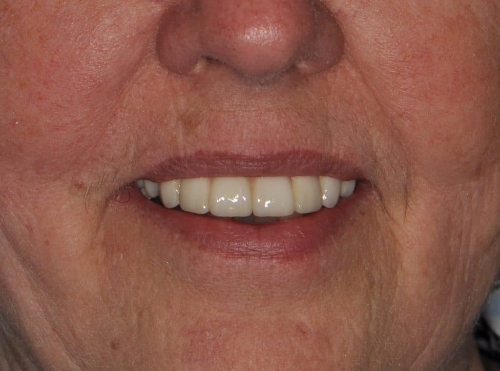After undefined - Cosmetic Dentistry