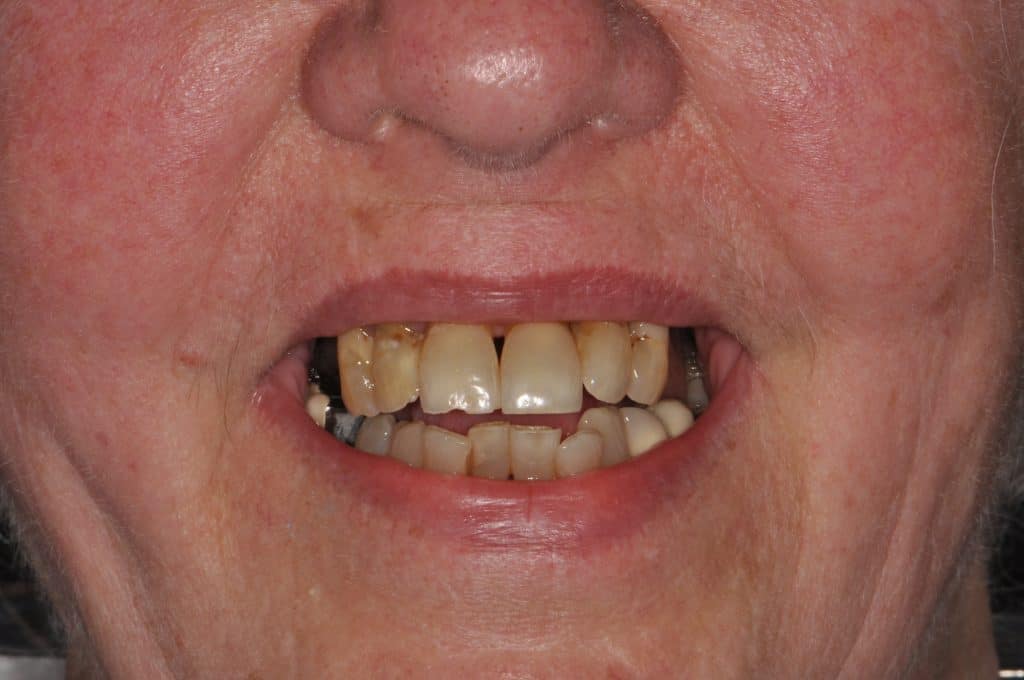 Before undefined - Cosmetic Dentistry