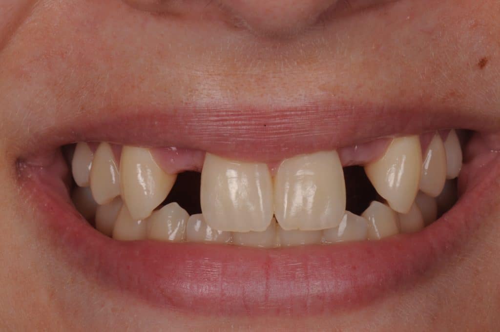 Before undefined - Cosmetic Dentistry