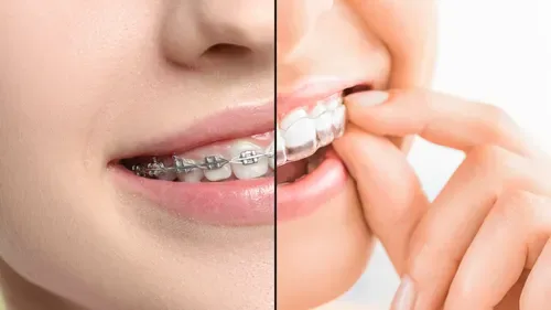 Clear Aligners vs Traditional Braces: Which Is Better?