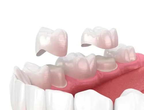 Complete Guide to Dental Crowns and Bridges: Everything You Need to Know