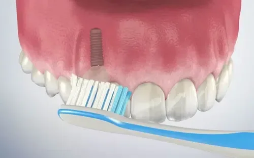 How to Care for Dental Implants: Complete Maintenance Guide