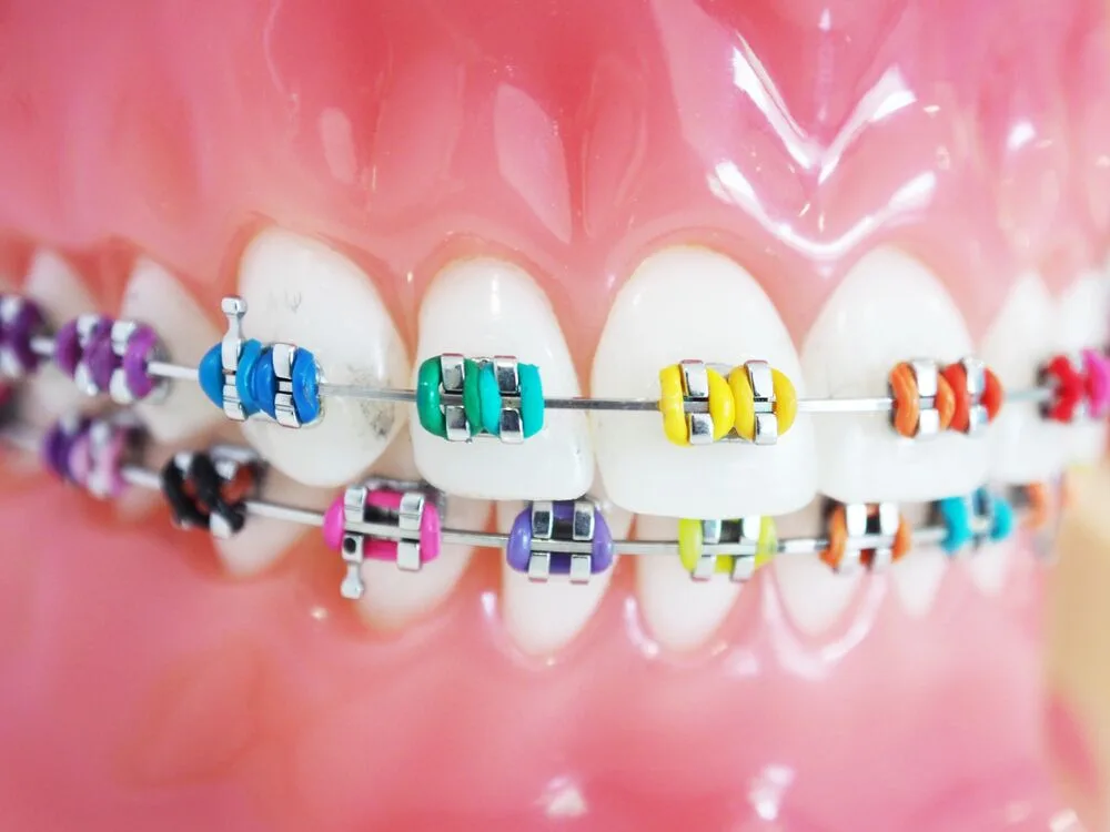 Dental Braces