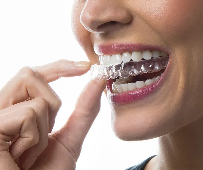 Clear Aligners
