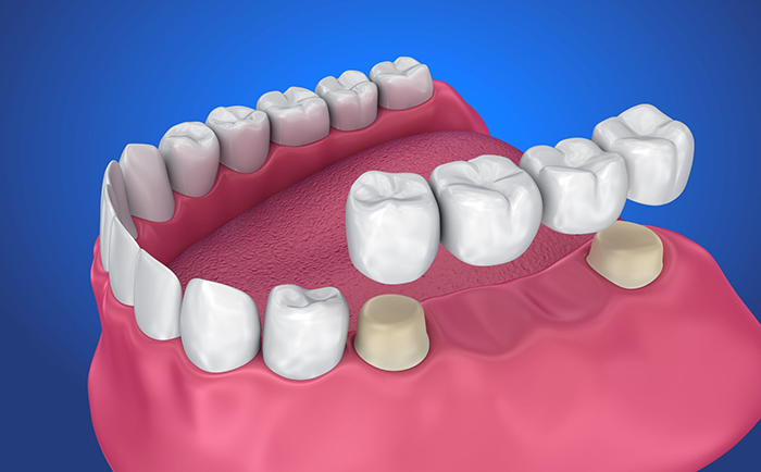 Dental Crowns & Bridges - Dr. Sushma Dental Clinic Hyderabad