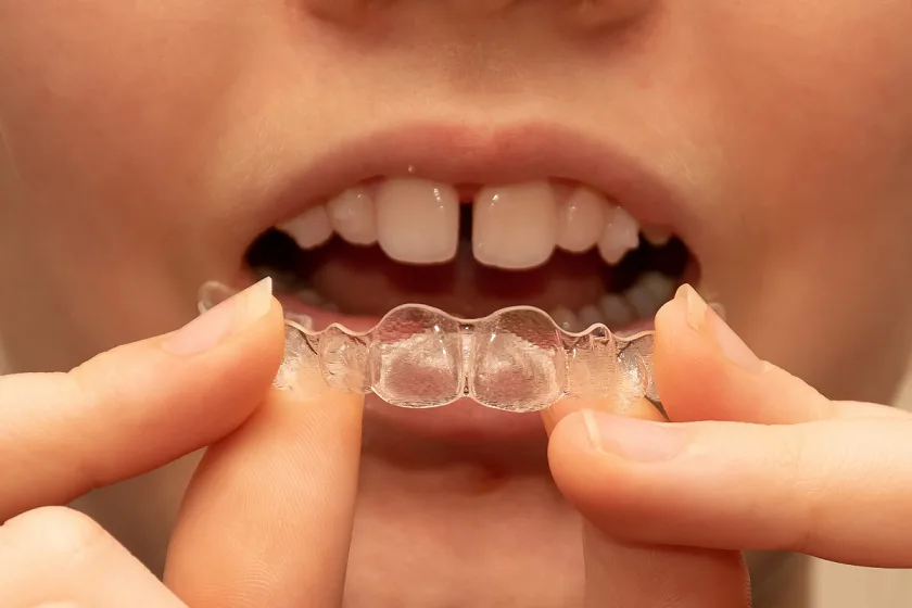 Teeth Gap Treatment