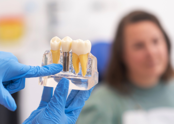 Dental Crowns & Bridges Anandbagh & Secunderabad