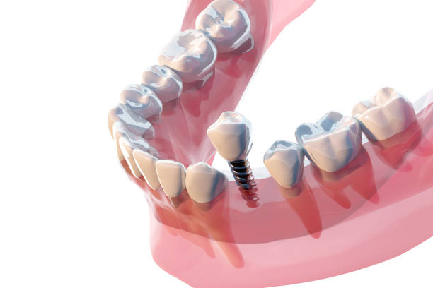 Dental Implants Hyderabad