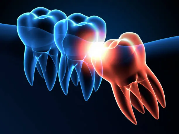 Wisdom Tooth Extraction Hyderabad
