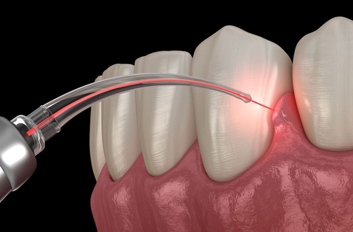Gum Treatment at Dr Sri Sushma Multispecialty Dental Clinic