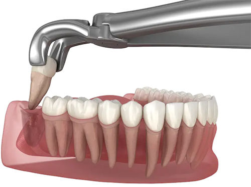 Wisdom Tooth Removal - Dr. Sushma Dental Clinic